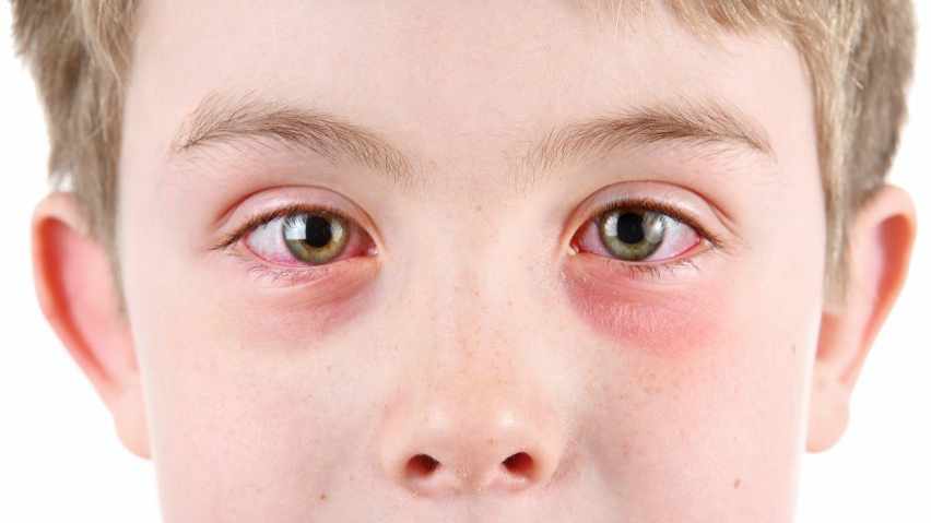 Qué hay que saber sobre la conjuntivitis?