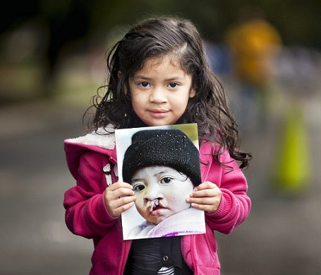 JOHNSON & JOHNSON Y OPERATION SMILE MÉXICO, SE UNEN CON 3 POR UN CAMBIO