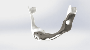 First Successful Operation With Custom 3D-Printed Titanium Lower Jaw