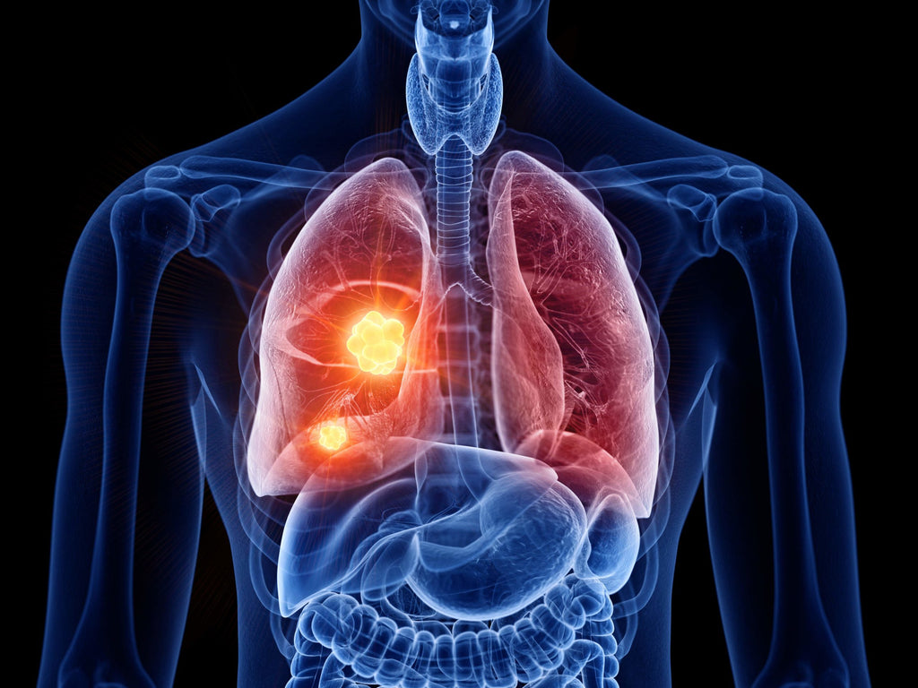 Con biomarcadores, en 72 horas mexicanos con cáncer de pulmón podrán acceder a medicina de precisión