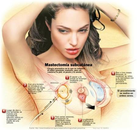Revolucionaria técnica de mastectomía preservando el pezón