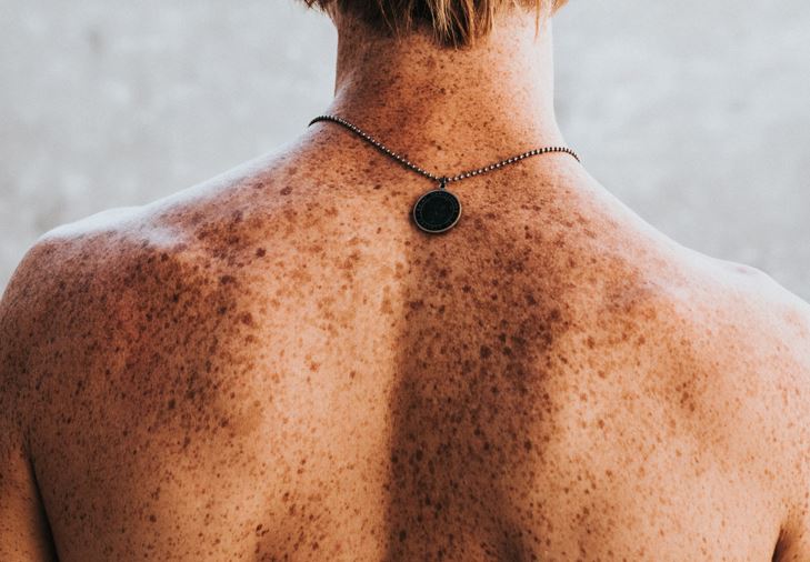 Irritación solar: ¿cómo prevenir daños en la piel?