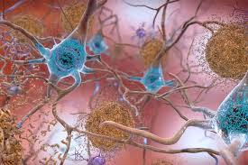Diabetes increases neuritic damage around amyloid plaques in Alzheimer’s disease