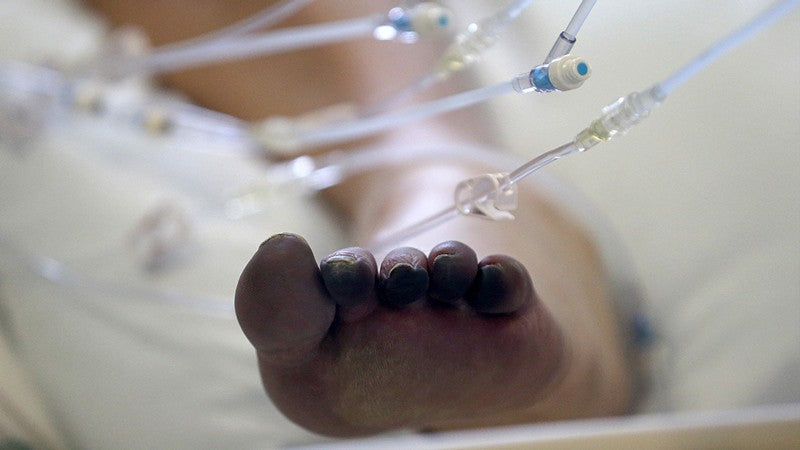 Are ‘COVID toes’ actually caused by the coronavirus?