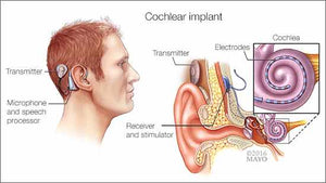 Los implantes cocleares, alternativa ante pérdida auditiva avanzada