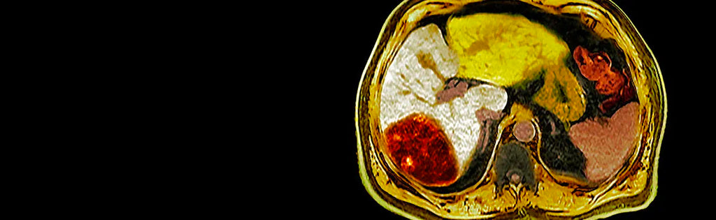 La oncología de trasplante transforma los resultados de los pacientes con tumores hepáticos inoperables