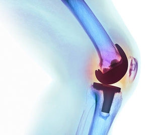 De vuelta al movimiento: Reemplazo de rodilla asistida por robots