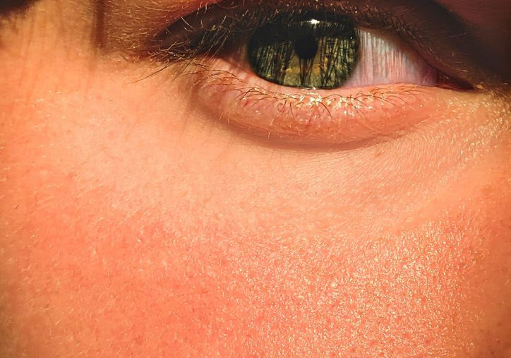 Piel hiperreactiva: ¿Qué es y cómo cuidarla?